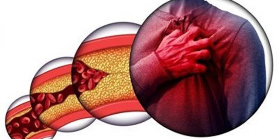 علاجات طبيعية تساعد في خفض الكوليسترول بالدم