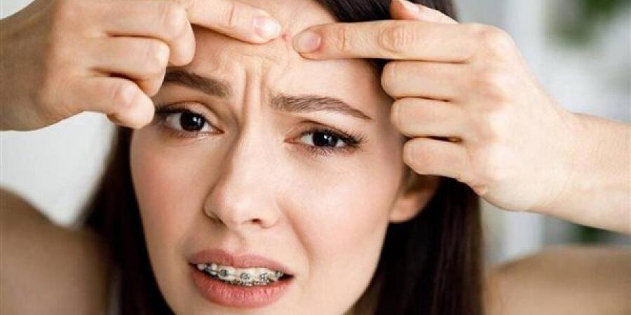 للنشر 8 ص.. وصفات طبيعية سريعة المفعول لعلاج حبوب الجبهة الصيفية